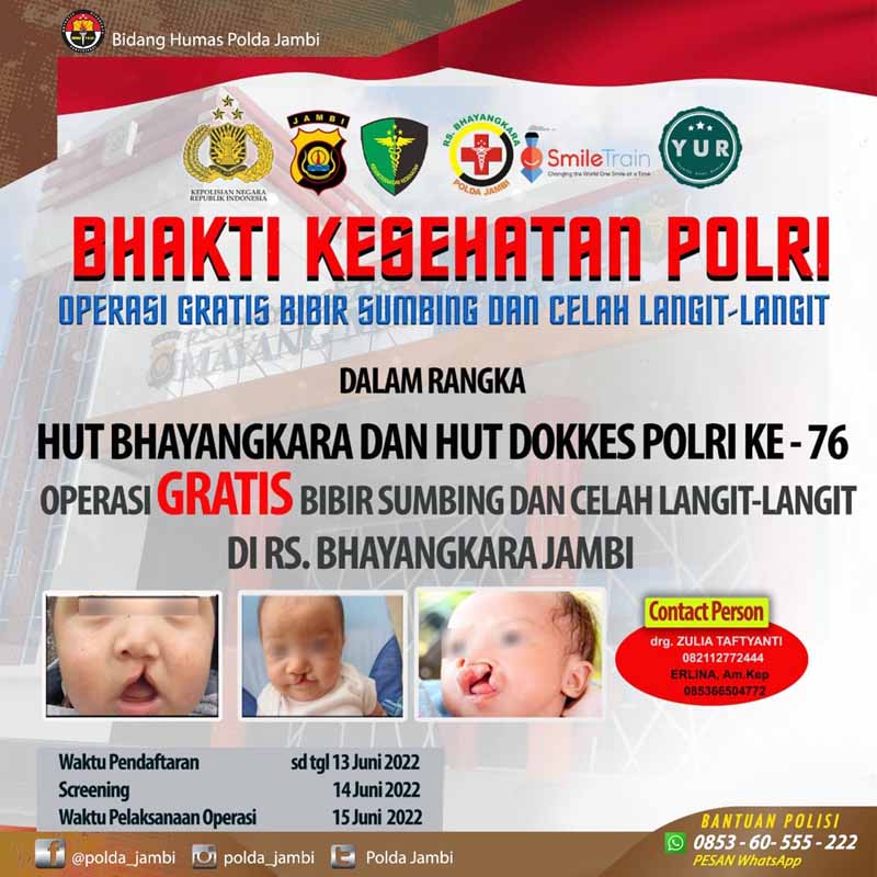 Polda Jambi dan RS Bhayangkara Adakan Operasi Bibir Sumbing dan Celah Langit-langit Gratis