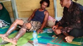 Satu Rumah di Desa Sungai Paur Terbakar, Kaki Pemilik Ikut Tersambar Api