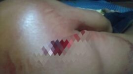Tangan Korban Luka Dibacok Oleh Orang Diduga Begal. FOTO : Ist