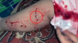Foto : Tangkapan layar kaki warga yang digigit Ular.
