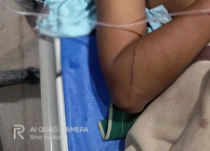 Kondisi Komar Hidatat (32) warga RT 09 Desa Suka Damai, Kecamatan Mestong, Kabupaten Muaro Jambi Usai Berkelahi dengan Beruang. FOTO : Dhea